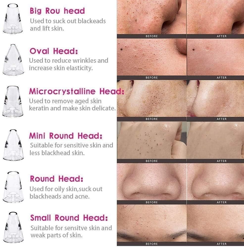 Multi-Function Blackhead Remover